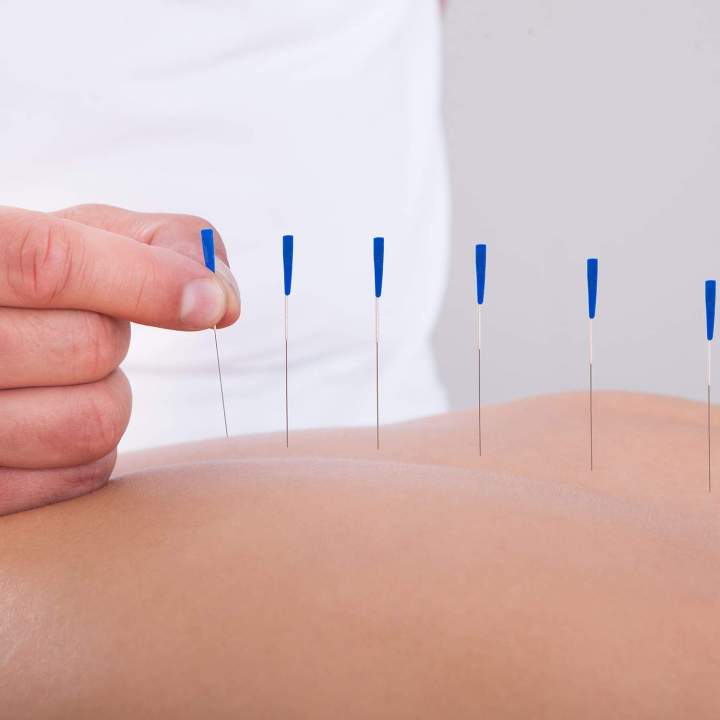 Acupuncture Mirabel