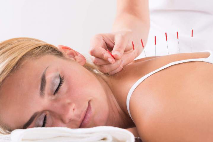 L’acupuncture Mirabel