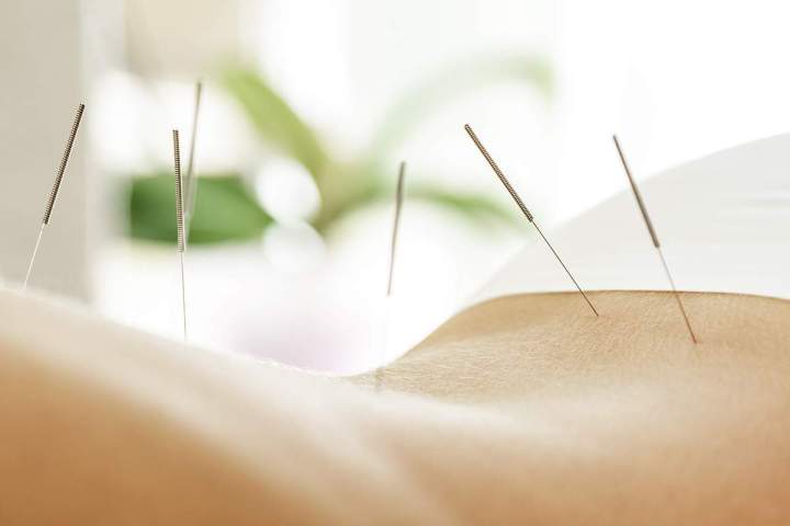Acupuncture Mirabel